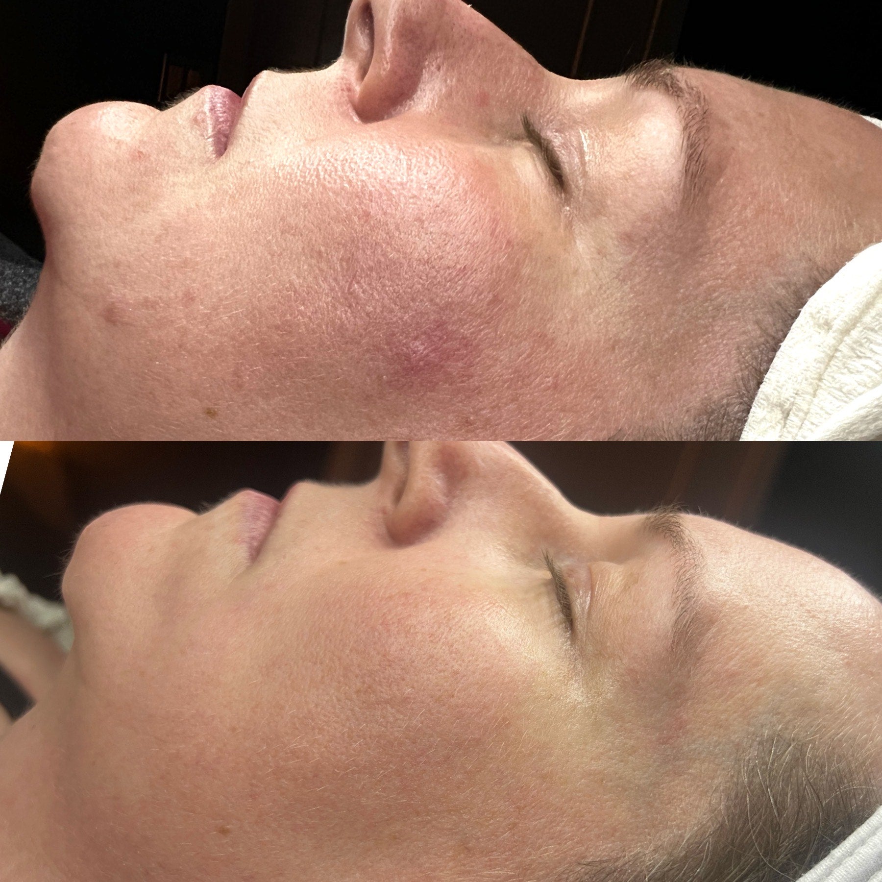 Stand Out in the Skincare Industry: Giovane RF Microneedling Sets Your Practice Apart!