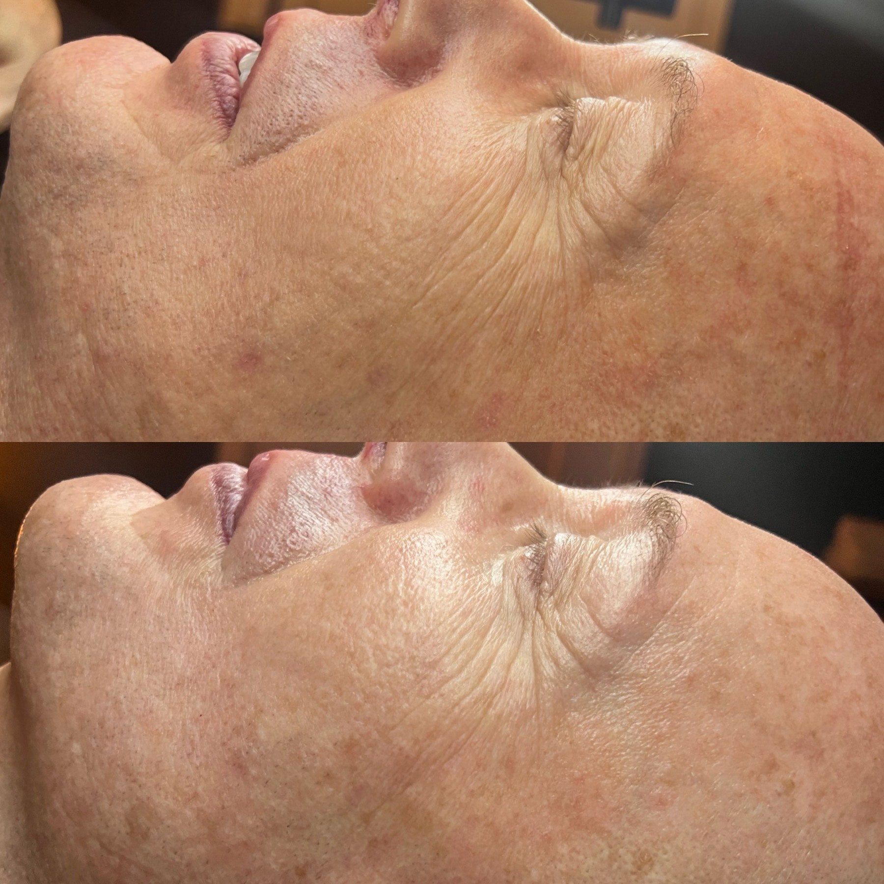 before after rf microneedling