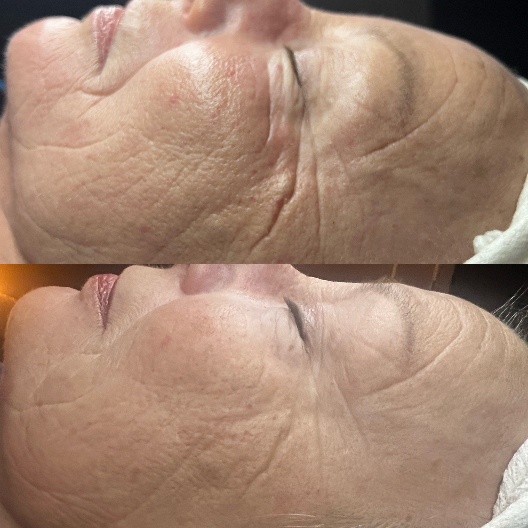 rf microneedling results before after 