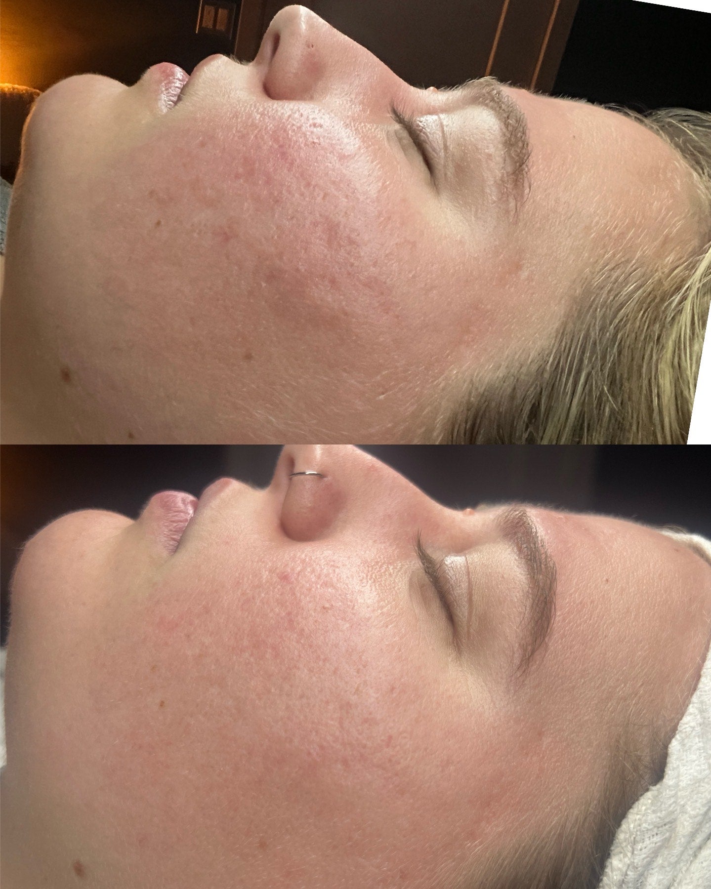 radio frequency microneedling results