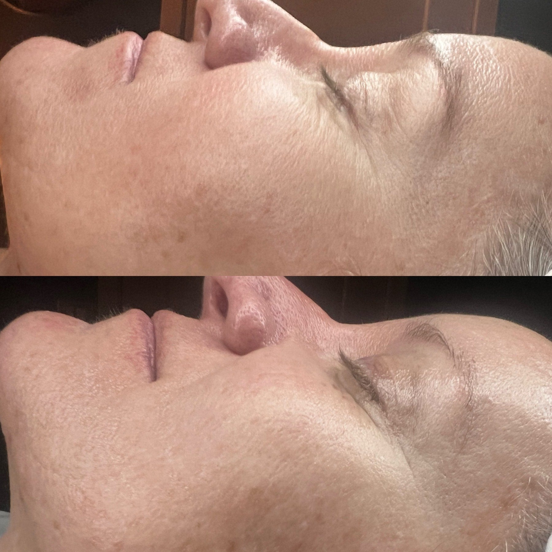 radio frequency microneedling results before after